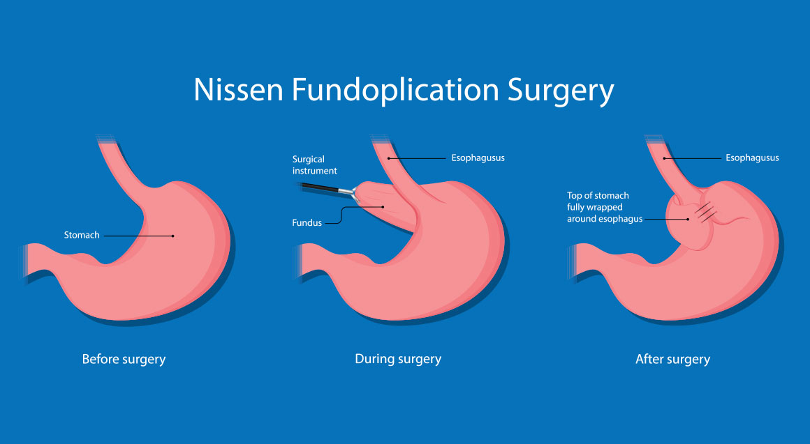 Nissen fundoplication surgery